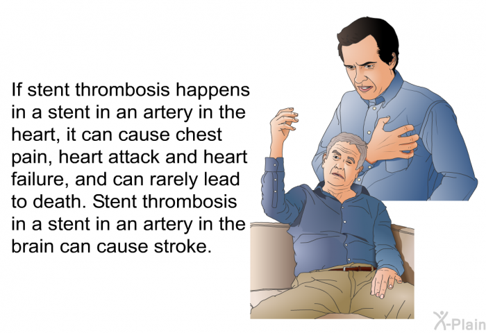 If stent thrombosis happens in a stent in an artery in the heart, it can cause chest pain, heart attack and heart failure, and can rarely lead to death. Stent thrombosis in a stent in an artery in the brain can cause stroke.