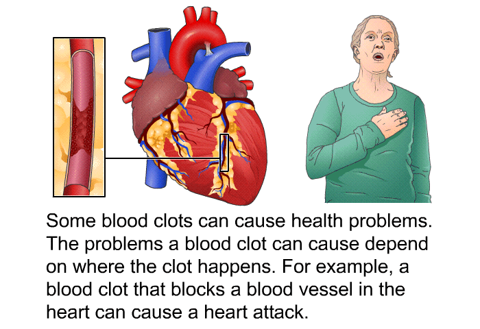 Some blood clots can cause health problems. The problems a blood clot can cause depend on where the clot happens. For example, a blood clot that blocks a blood vessel in the heart can cause a heart attack.