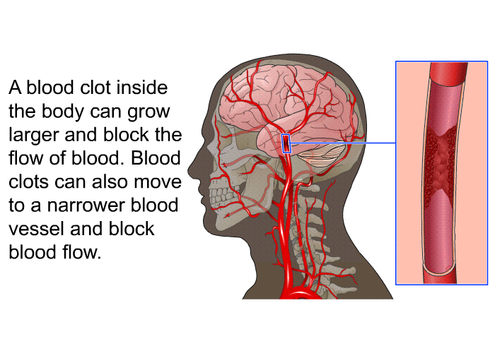 A blood clot inside the body can grow larger and block the flow of blood. Blood clots can also move to a narrower blood vessel and block blood flow.