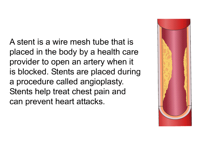 A stent is a wire mesh tube that is placed in the body by a health care provider to open an artery when it is blocked. Stents are placed during a procedure called angioplasty. Stents help treat chest pain and can prevent heart attacks.