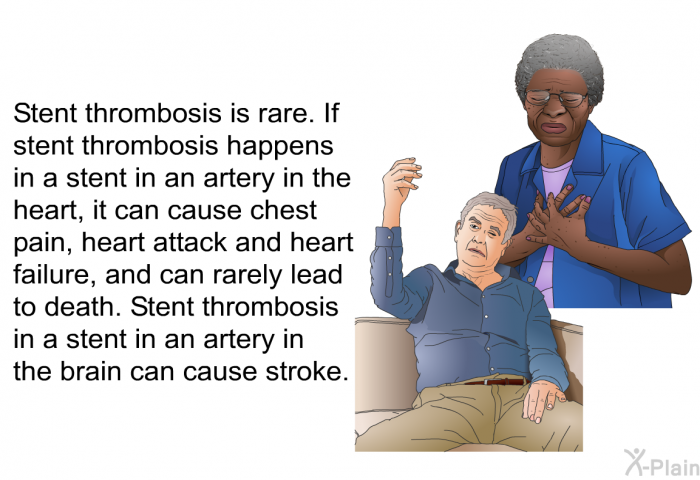 Stent thrombosis is rare. If stent thrombosis happens in a stent in an artery in the heart, it can cause chest pain, heart attack and heart failure, and can rarely lead to death. Stent thrombosis in a stent in an artery in the brain can cause stroke.