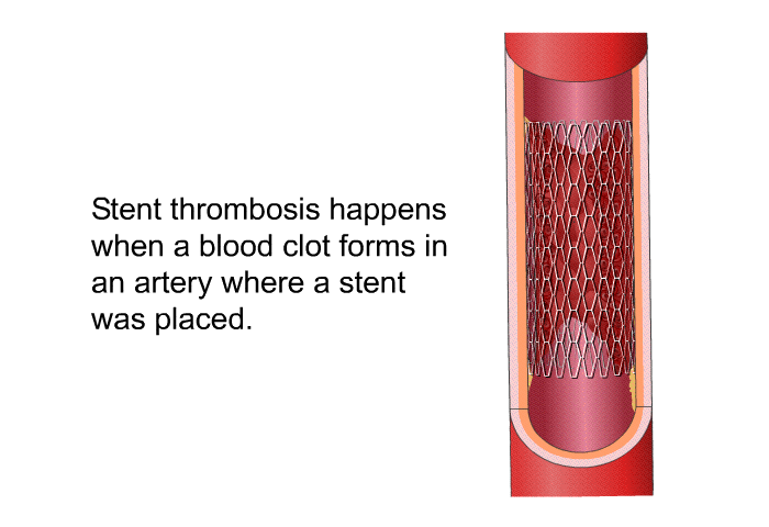 Stent thrombosis happens when a blood clot forms in an artery where a stent was placed.