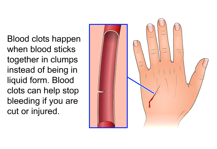 Blood clots happen when blood sticks together in clumps instead of being in liquid form. Blood clots can help stop bleeding if you are cut or injured.