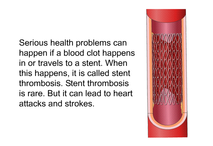 Serious health problems can happen if a blood clot happens in or travels to a stent. When this happens, it is called stent thrombosis. Stent thrombosis is rare. But it can lead to heart attacks and strokes.