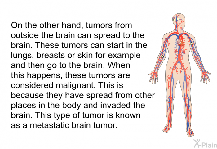 On the other hand, tumors from outside the brain can spread to the brain. These tumors can start in the lungs, breasts or skin for example and then go to the brain. When this happens, these tumors are considered malignant. This is because they have spread from other places in the body and invaded the brain. This type of tumor is known as a metastatic brain tumor.