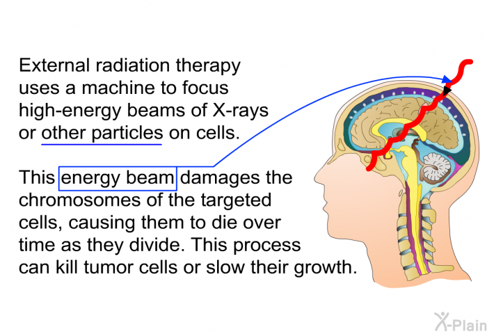 External radiation therapy uses a machine to focus high-energy beams of X-rays or other particles on cells. This energy beam damages the chromosomes of the targeted cells, causing them to die over time as they divide. This process can kill tumor cells or slow their growth.