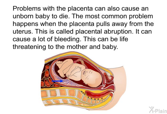 Problems with the placenta can also cause an unborn baby to die. The most common problem happens when the placenta pulls away from the uterus. This is called placental abruption. It can cause a lot of bleeding. This can be life threatening to the mother and baby.