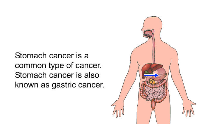 Stomach cancer is a common type of cancer. Stomach cancer is also known as gastric cancer.