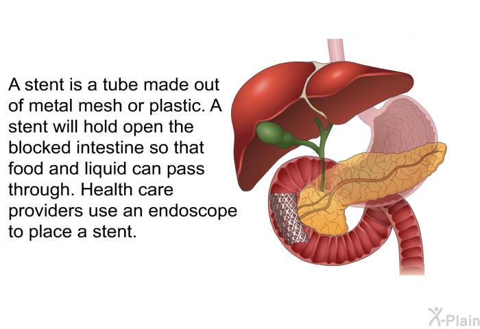 A stent is a tube made out of metal mesh or plastic. A stent will hold open the blocked intestine so that food and liquid can pass through. Health care providers use an endoscope to place a stent.