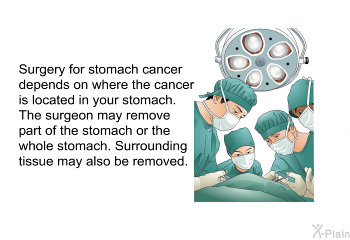 Surgery for stomach cancer depends on where the cancer is located in your stomach. The surgeon may remove part of the stomach or the whole stomach. Surrounding tissue may also be removed.