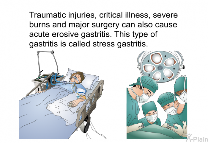 Traumatic injuries, critical illness, severe burns and major surgery can also cause acute erosive gastritis. This type of gastritis is called stress gastritis.