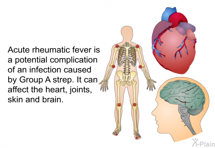 Acute rheumatic fever is a potential complication of an infection caused by Group A strep. It can affect the heart, joints, skin and brain.