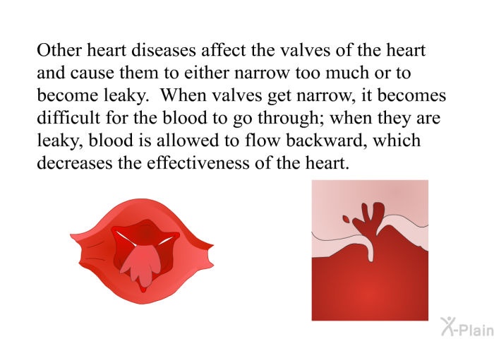 Other heart diseases affect the valves of the heart and cause them to either narrow too much or to become leaky. When valves get narrow, it becomes difficult for the blood to go through; when they are leaky, blood is allowed to flow backward, which decreases the effectiveness of the heart.