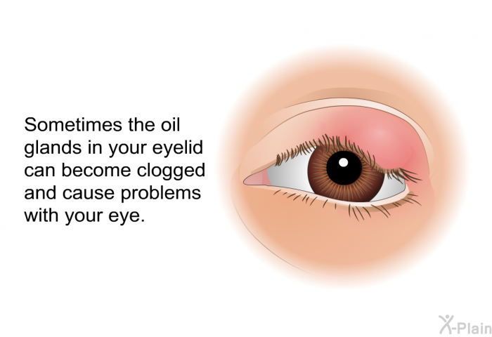 Sometimes the oil glands in your eyelid can become clogged and cause problems with your eye.