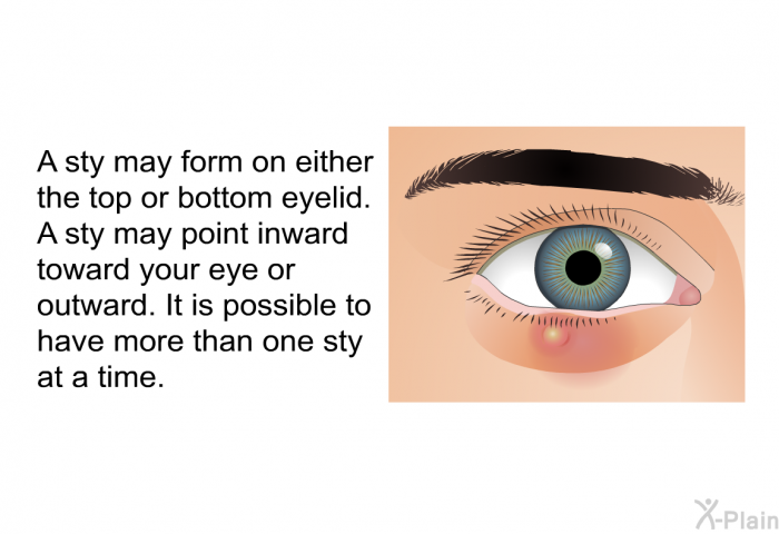 A sty may form on either the top or bottom eyelid. A sty may point inward toward your eye or outward. It is possible to have more than one sty at a time.