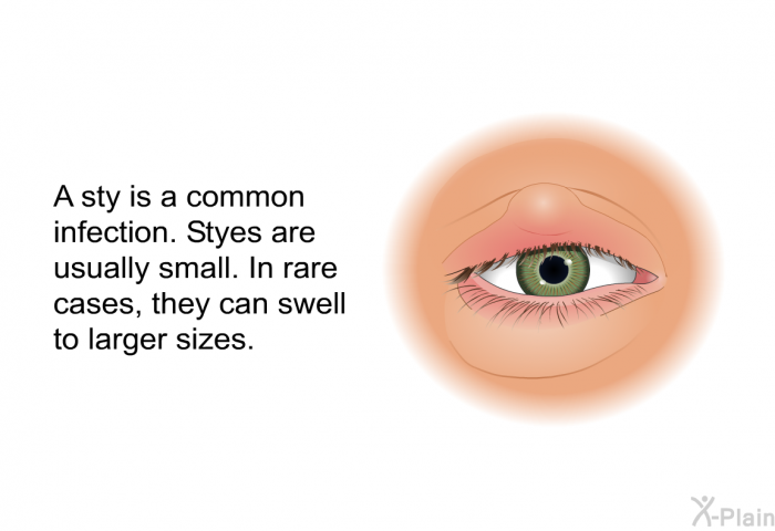 A sty is a common infection. Styes are usually small. In rare cases, they can swell to larger sizes.