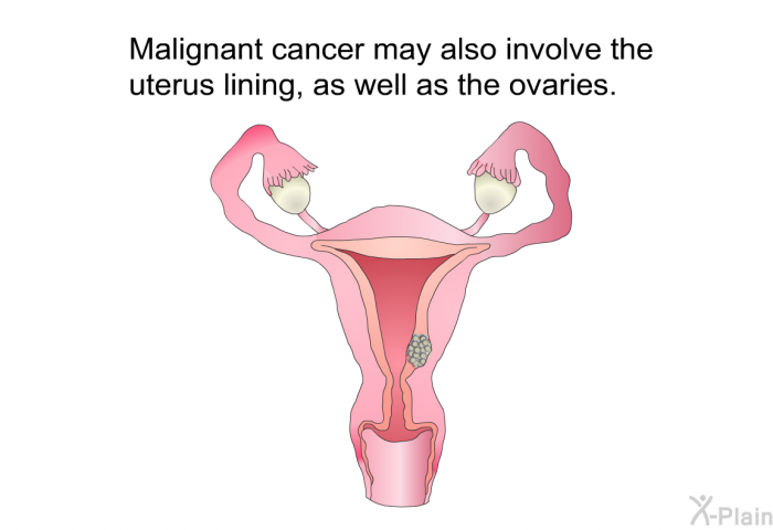 Malignant cancer may also involve the uterus lining, as well as the ovaries.