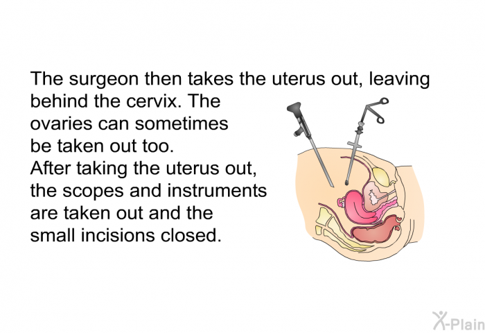 The surgeon then takes the uterus out, leaving behind the cervix. The ovaries can sometimes be taken out too. 
 After taking the uterus out, the scopes and instruments are taken out and the small incisions closed.