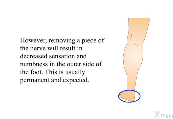 However, removing a piece of the nerve will result in decreased sensation and numbness in the outer side of the foot. This is usually permanent and expected.