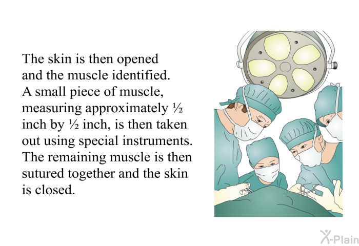 The skin is then opened and the muscle identified. A small piece of muscle, measuring approximately &frac12; inch by &frac12; inch, is then taken out using special instruments. The remaining muscle is then sutured together and the skin is closed.