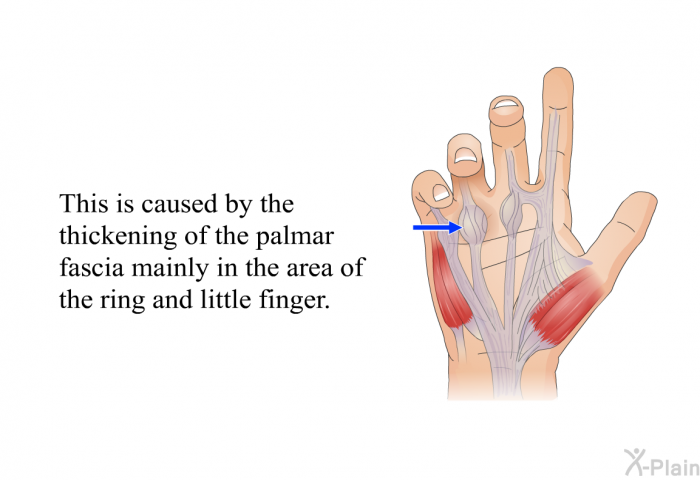This is caused by the thickening of the palmar fascia mainly in the area of the ring and little finger.