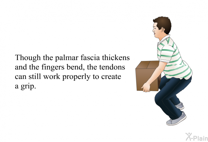 Though the palmar fascia thickens and the fingers bend, the tendons can still work properly to create a grip.