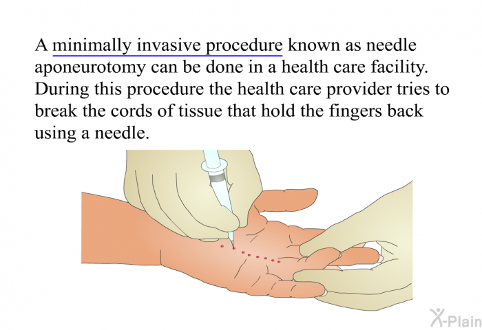 A minimally invasive procedure known as needle aponeurotomy can be done in a health care facility. During this procedure the health care provider tries to break the cords of tissue that hold the fingers back using a needle.