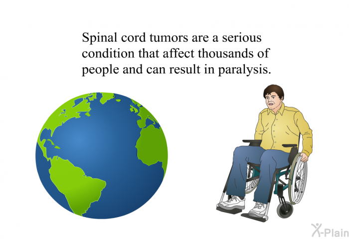 Spinal cord tumors are a serious condition that affect thousands of people and can result in paralysis.