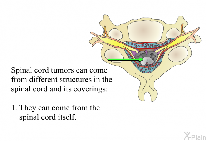 Spinal cord tumors can come from different structures in the spinal cord and its coverings:  They can come from the spinal cord itself.