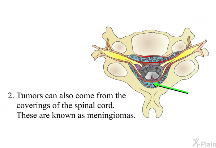 Tumors can also come from the coverings of the spinal cord. These are known as meningiomas.