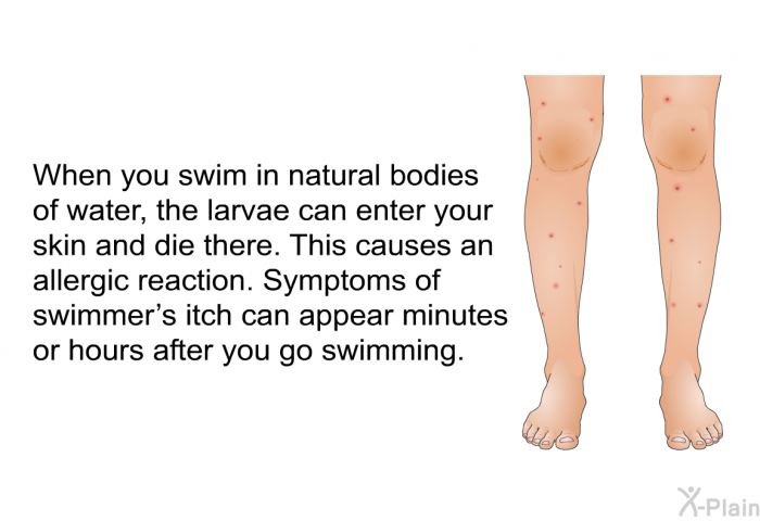 When you swim in natural bodies of water, the larvae can enter your skin and die there. This causes an allergic reaction. Symptoms of swimmer's itch can appear minutes or hours after you go swimming.