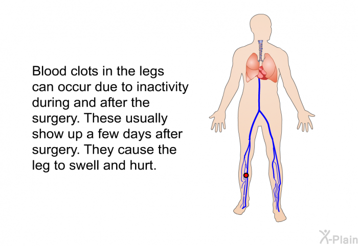 Blood clots in the legs can occur due to inactivity during and after the surgery. These usually show up a few days after surgery. They cause the leg to swell and hurt.