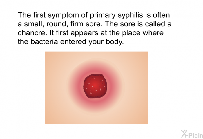 The first symptom of primary syphilis is often a small, round, firm sore. The sore is called a chancre. It first appears at the place where the bacteria entered your body.