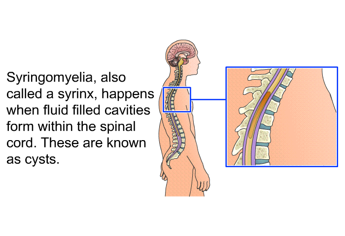 Syringomyelia, also called a syrinx, happens when fluid filled cavities form within the spinal cord. These are known as cysts.