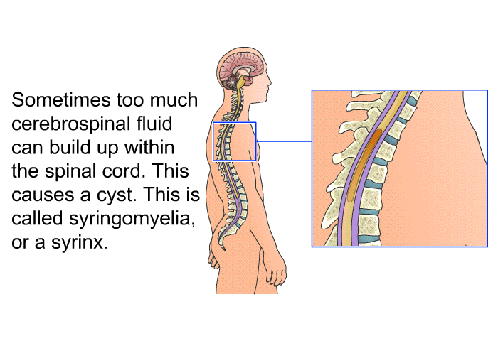 Sometimes too much cerebrospinal fluid can build up within the spinal cord. This causes a cyst. This is called syringomyelia, or a syrinx.