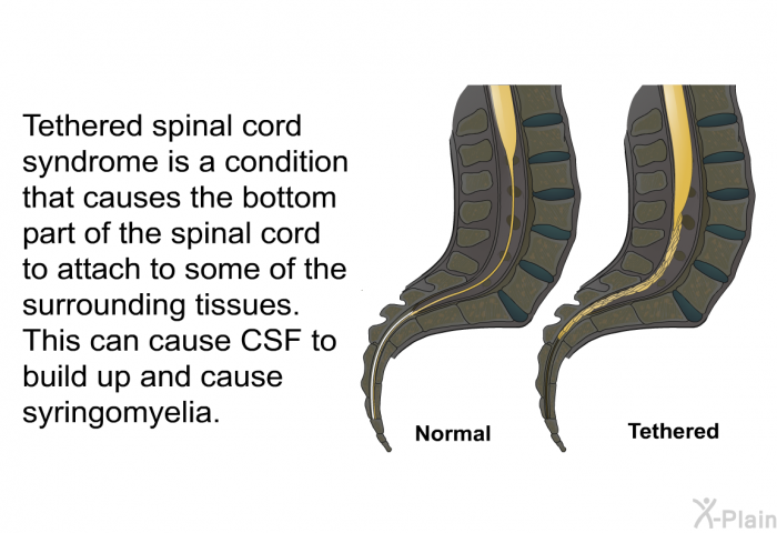 Tethered spinal cord syndrome is a condition that causes the bottom part of the spinal cord to attach to some of the surrounding tissues. This can cause CSF to build up and cause syringomyelia.