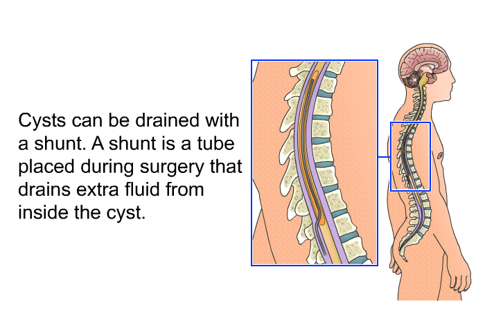 Cysts can be drained with a shunt. A shunt is a tube placed during surgery that drains extra fluid from inside the cyst.