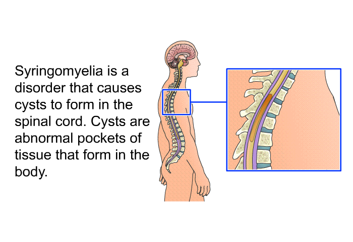 Syringomyelia is a disorder that causes cysts to form in the spinal cord. Cysts are abnormal pockets of tissue that form in the body.