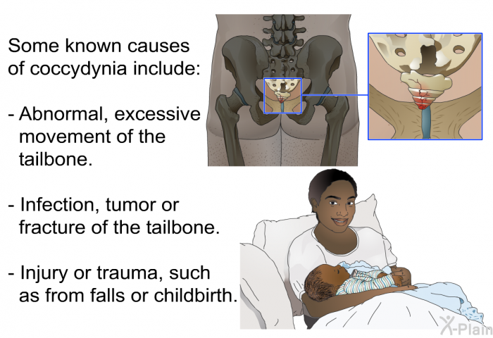 Some known causes of coccydynia include:  Abnormal, excessive movement of the tailbone. Infection, tumor or fracture of the tailbone. Injury or trauma, such as from falls or childbirth.