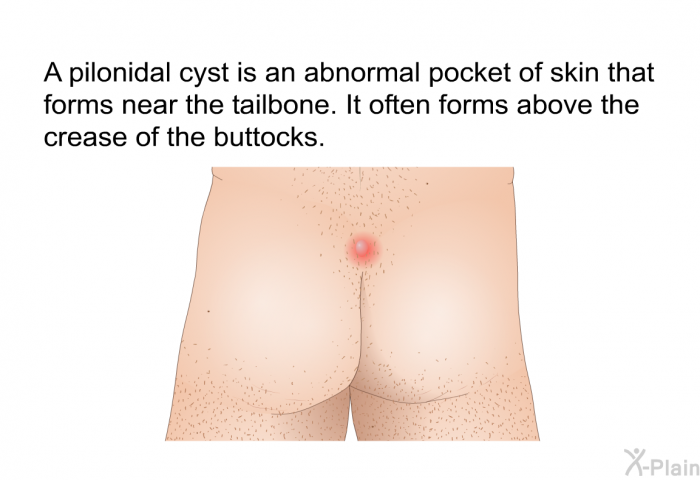 A pilonidal cyst is an abnormal pocket of skin that forms near the tailbone. It often forms above the crease of the buttocks.