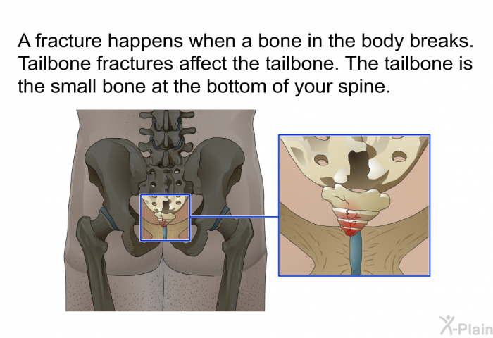 A fracture happens when a bone in the body breaks. Tailbone fractures affect the tailbone. The tailbone is the small bone at the bottom of your spine.