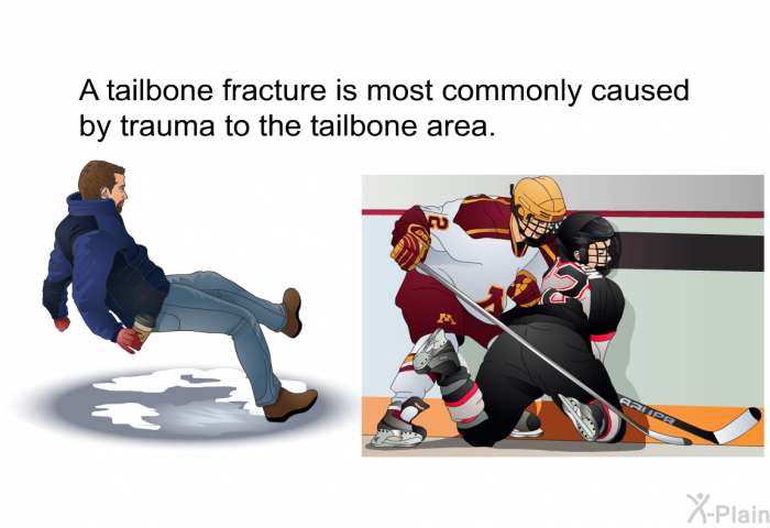 A tailbone fracture is most commonly caused by trauma to the tailbone area.