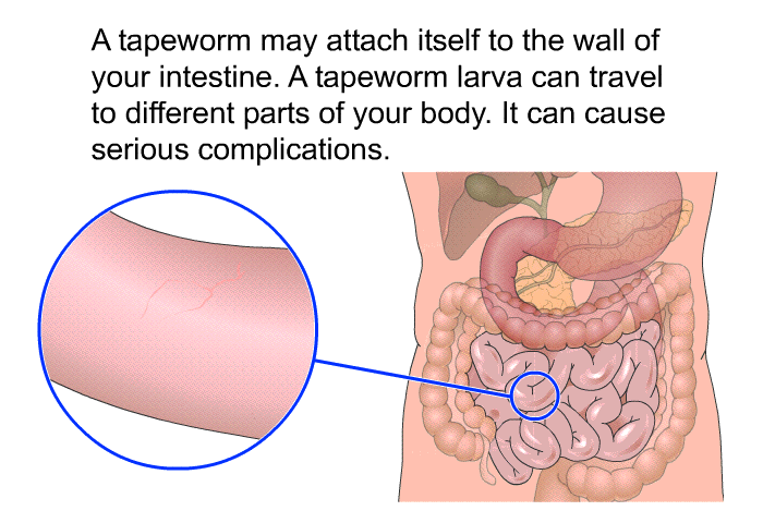 A tapeworm may attach itself to the wall of your intestine. A tapeworm larva can travel to different parts of your body. It can cause serious complications.