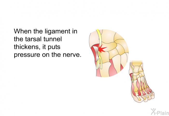 When the ligament in the tarsal tunnel thickens, it puts pressure on the nerve.