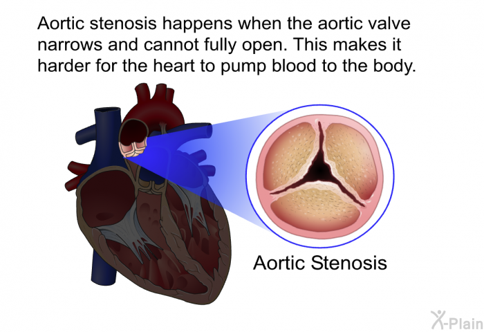 Aortic stenosis happens when the aortic valve narrows and cannot fully open. This makes it harder for the heart to pump blood to the body.