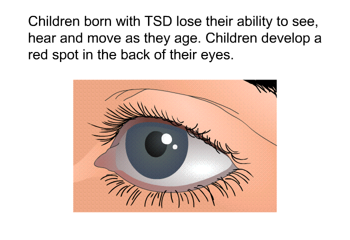 Children born with TSD lose their ability to see, hear and move as they age. Children develop a red spot in the back of their eyes.