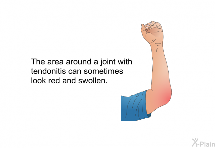 The area around a joint with tendonitis can sometimes look red and swollen.