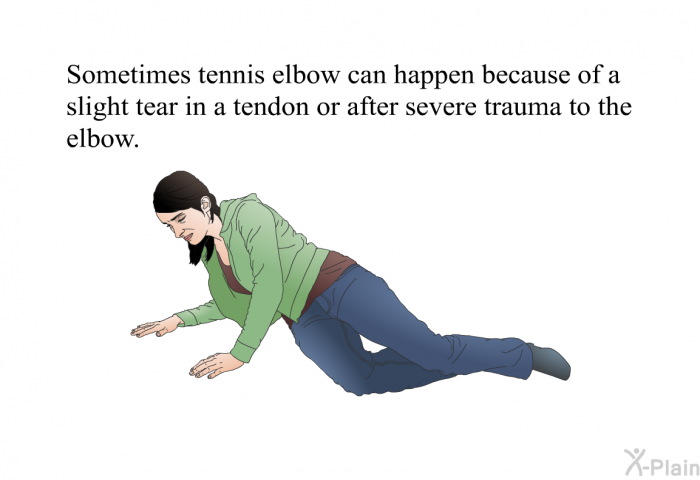 Sometimes tennis elbow can happen because of a slight tear in a tendon or after severe trauma to the elbow.