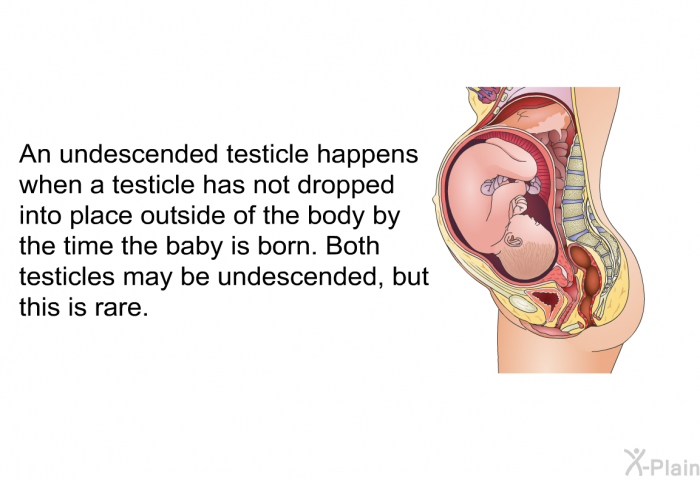 An undescended testicle happens when a testicle has not dropped into place outside of the body by the time the baby is born. Both testicles may be undescended, but this is rare.
