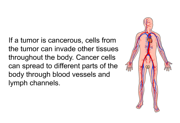 If a tumor is cancerous, cells from the tumor can invade other tissues throughout the body. Cancer cells can spread to different parts of the body through blood vessels and lymph channels.